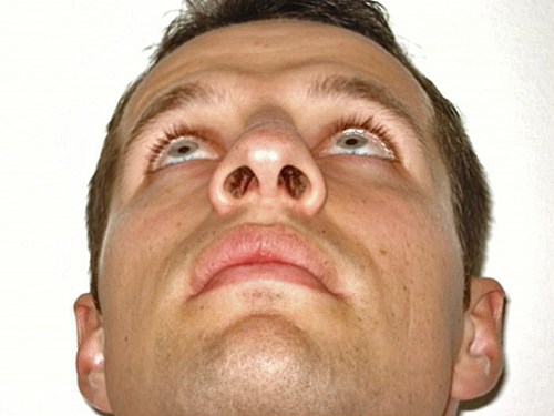 Perfekter Mittelstand des Nasenstegs mit gleich grossen Nasenöffnungen