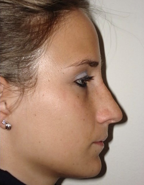 Gerades Profil, Nasenlänge reduziert